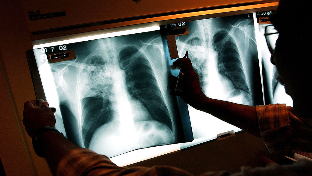 2 active tuberculosis cases traced to San Francisco strip club — KTVU FOX 2 Bay Area, Sunnyvale Health news